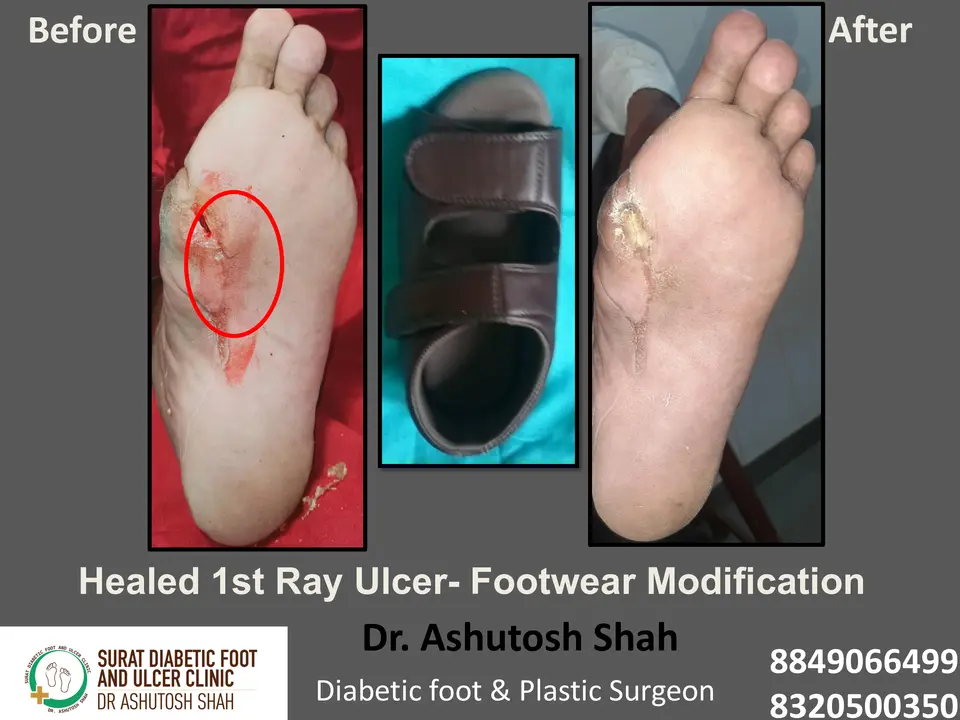 Diabetic Foot  PPT 3 checked by sir.pptx-19.webp